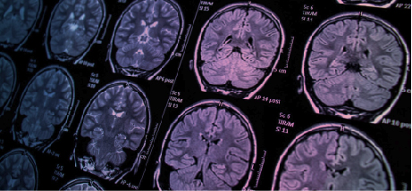 É possível acabar com os fogachos da menopausa?