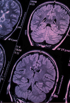 É possível acabar com os fogachos da menopausa?