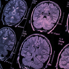 É possível acabar com os fogachos da menopausa?